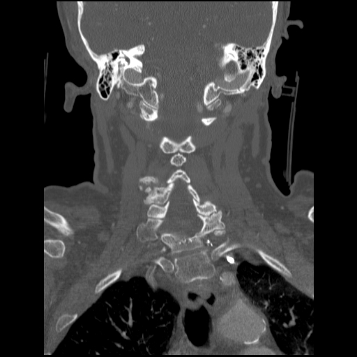File:C1 anterior arch (plough) fracture - type 1 (Radiopaedia 76181-87720 Coronal bone window 42).jpg