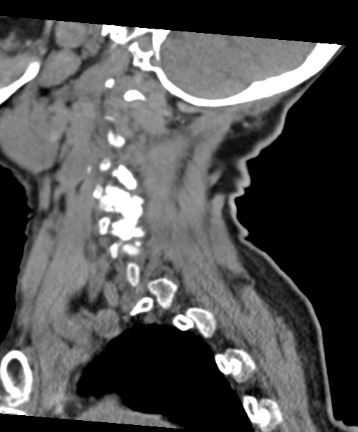 C2 fracture with vertebral artery dissection (Radiopaedia 37378-39199 D 21).png
