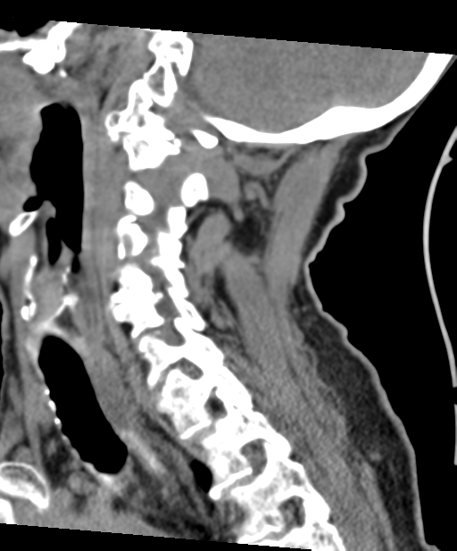 C2 fracture with vertebral artery dissection (Radiopaedia 37378-39199 D 31).png