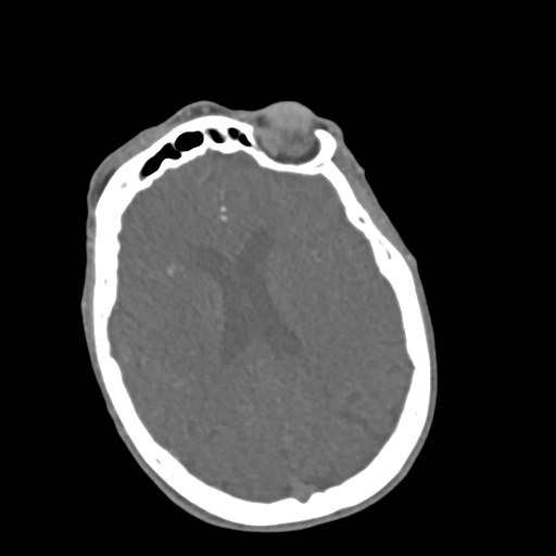 File:C2 fracture with vertebral artery dissection (Radiopaedia 37378-39200 A 263).png