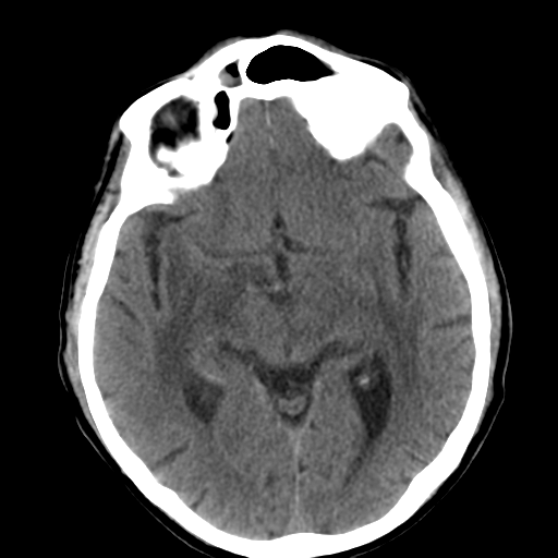 File:CNS lymphoma (Radiopaedia 36983-38639 Axial non-contrast 18).png