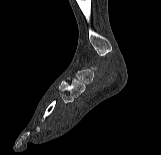 Calcaneal fracture - Sanders type 4 (Radiopaedia 90179-107370 Sagittal bone window 33).jpg
