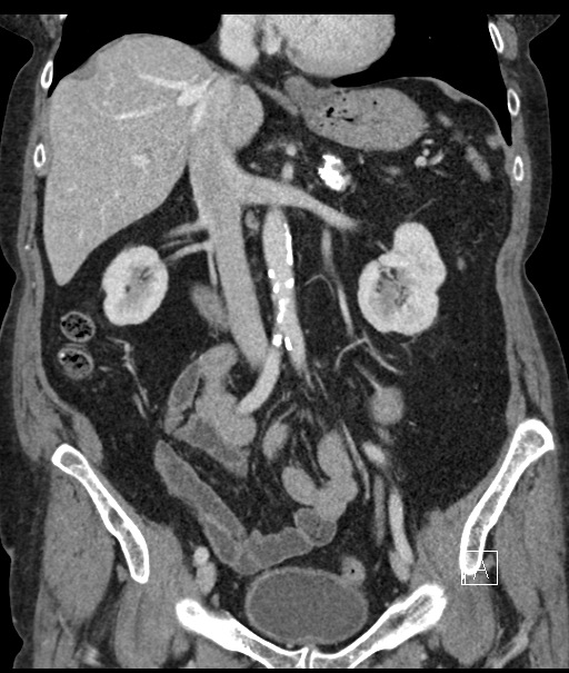 Calcified adrenal glands and Spigelian hernia (Radiopaedia 49741-54988 B 54).jpg