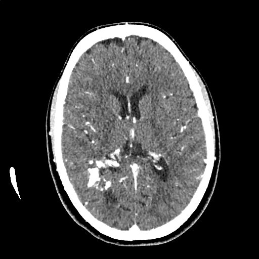 Calcified cerebral hydatid cyst (Radiopaedia 65603-74717 Axial with contrast 42).jpg