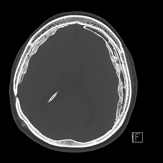 Calcified chronic subdural hematoma (Radiopaedia 77374-89492 Axial bone window 86).jpg