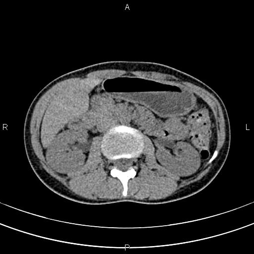 File:Calcified hepatic hydatid cyst (Radiopaedia 83870-99072 Axial non-contrast 75).jpg