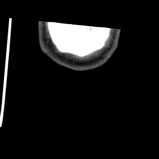 Calcifying pseudoneoplasm of neuraxis (Radiopaedia 44076-47617 Coronal non-contrast 53).png
