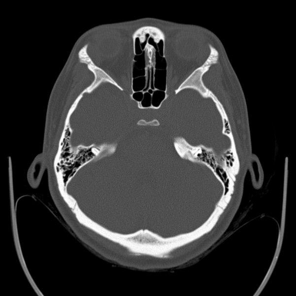 Calvarial osteoma (Radiopaedia 36520-38079 Axial bone window 32).jpg