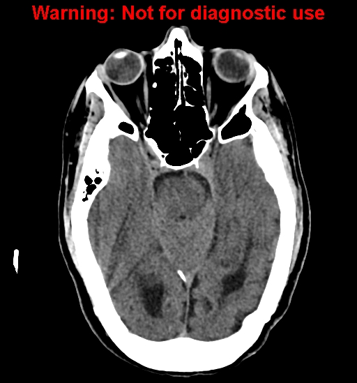 File:Calvarial thickening from chronic shunting (Radiopaedia 60079-67637 Axial non-contrast 12).jpg