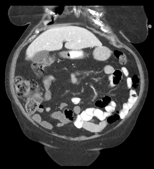 Cannonball metastases from endometrial cancer (Radiopaedia 42003-45031 F 22).png