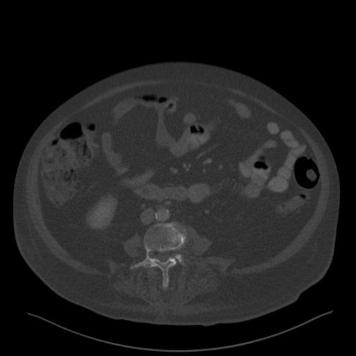 File:Cannonball metastases from endometrial cancer (Radiopaedia 42003-45031 H 1).png