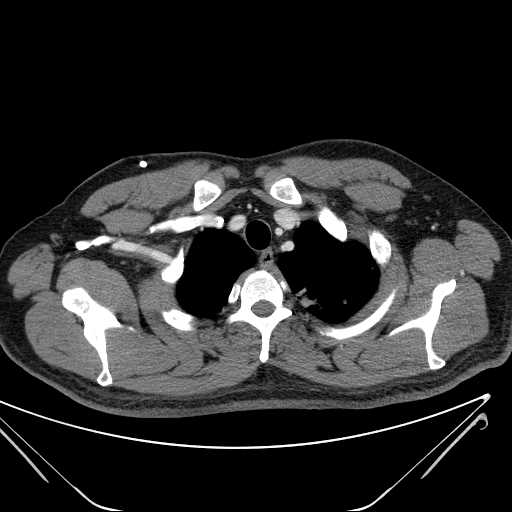 File:Cannonball pulmonary metastases (Radiopaedia 67684-77101 D 36).jpg