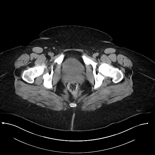 Carcinoid tumor - terminal ileum (Radiopaedia 60931-68740 Axial non-contrast 124).jpg