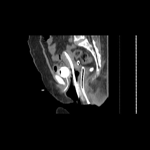Carcinoma cervix- brachytherapy applicator (Radiopaedia 33135-34173 D 87).jpg