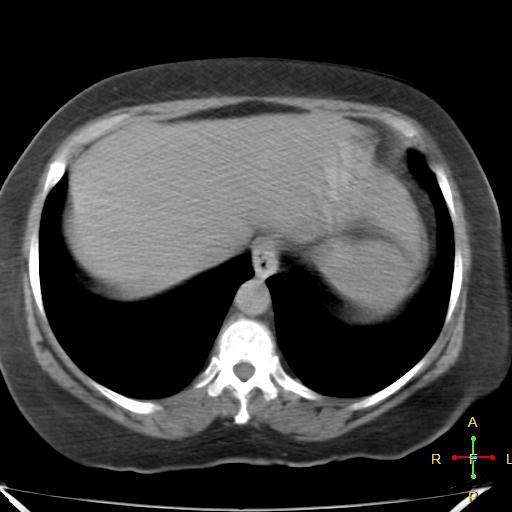 File:Carcinoma of sigmoid colon (Radiopaedia 23071-23100 C+ delayed 2).jpg