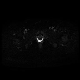 Carcinoma of the cervix (Radiopaedia 89018-105858 Axial DWI 7).jpg