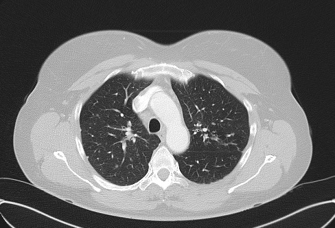 File:Cardiac sarcoidosis (Radiopaedia 74548-85534 Axial lung window 24).jpg