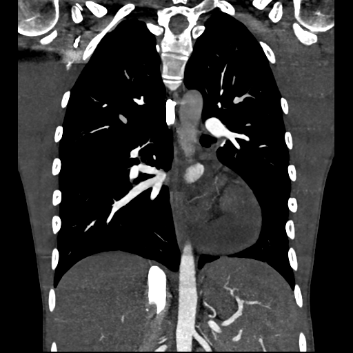 File:Cardiac tumor - undifferentiated pleomorphic sarcoma (Radiopaedia 45844-50134 Coronal non-contrast 42).png