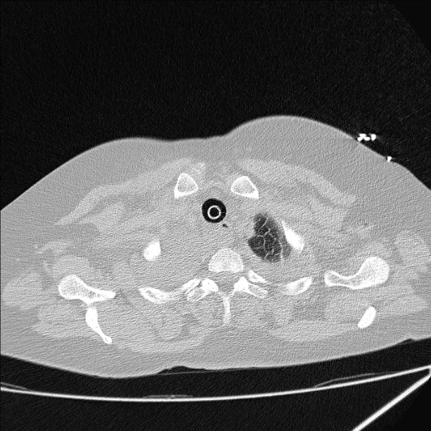 Cardiogenic pulmonary edema (Radiopaedia 29213-29609 Axial lung window 5).jpg