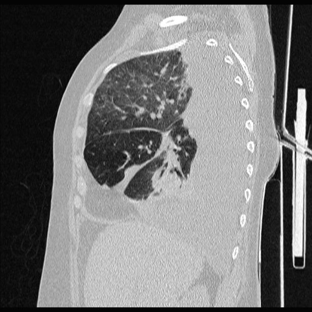 Cardiogenic pulmonary edema (Radiopaedia 29213-29609 Sagittal lung window 30).jpg