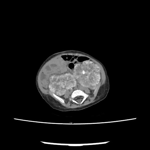 File:Caroli disease with autosomal recessive polycystic kidney disease (ARPKD) (Radiopaedia 89651-106703 E 167).jpg