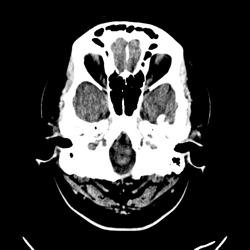 File:Carotico ophthalmic aneurysm (Radiopaedia 42916-46147 Axial non-contrast 2).png