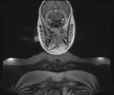 File:Carotid body tumor (Radiopaedia 12777-12912 MRA 8).jpg