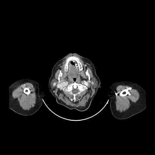 File:Carotid body tumor (Radiopaedia 21021-20948 B 8).jpg