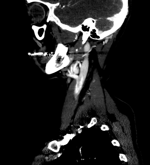 File:Carotid body tumor (Radiopaedia 39845-42300 D 3).jpg