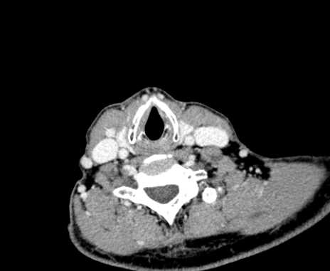 File:Carotid body tumor (Radiopaedia 61750-69757 Axial Post contrast 85).jpg