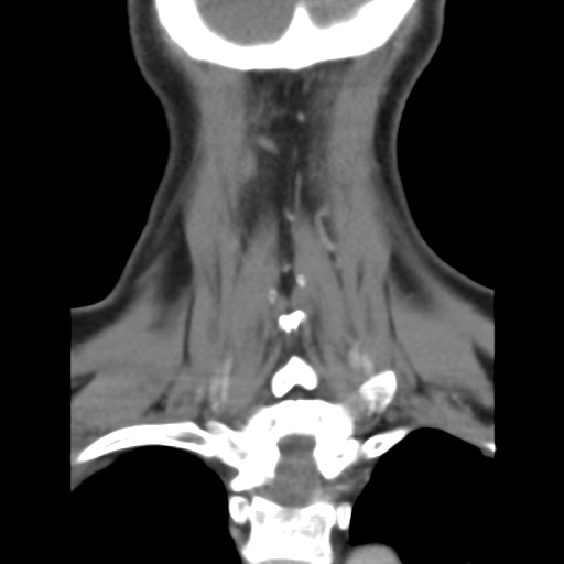 File:Carotid body tumor (paraganglioma) (Radiopaedia 38586-40729 B 36).jpg