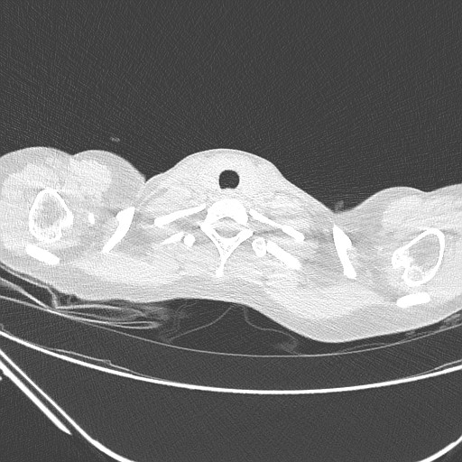 Catamenial pneumothorax (Radiopaedia 27946-28197 lung window 14).jpg
