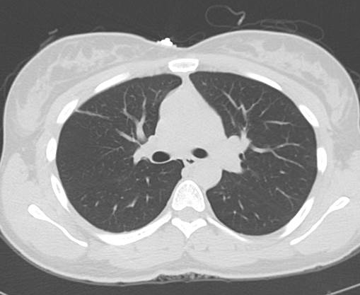 File:Catamenial pneumothorax (Radiopaedia 54382-60600 Axial 9).png