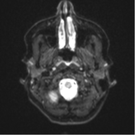 File:Cavernoma with bleed - midbrain (Radiopaedia 54546-60774 Axial DWI 1).png