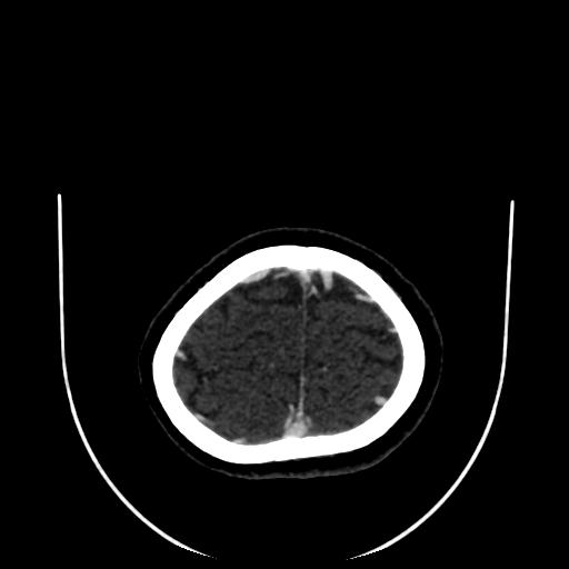 Cavernoma with developmental venous anomaly (Radiopaedia 22470-22506 C 181).jpg