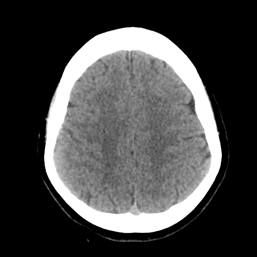 Cavernoma with hemorrhage (Radiopaedia 70755-80931 Axial non-contrast 39).png