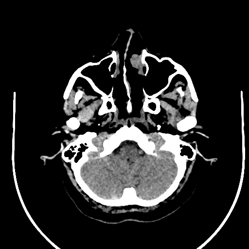 Cavernous hemangioma of the cerebellar falx (Radiopaedia 73025-83723 Axial non-contrast 18).jpg