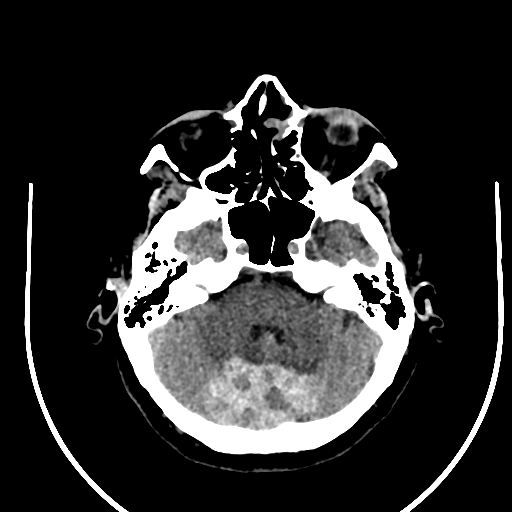 Cavernous hemangioma of the cerebellar falx (Radiopaedia 73025-83723 Axial non-contrast 34).jpg