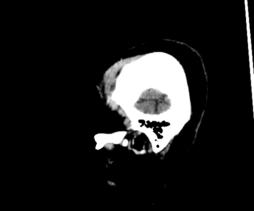 Cavernous hemangioma of the cerebellar falx (Radiopaedia 73025-83723 B 29).jpg