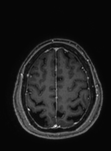 Cavernous hemangioma of the cerebellar falx (Radiopaedia 73025-83724 Axial T1 C+ 72).jpg