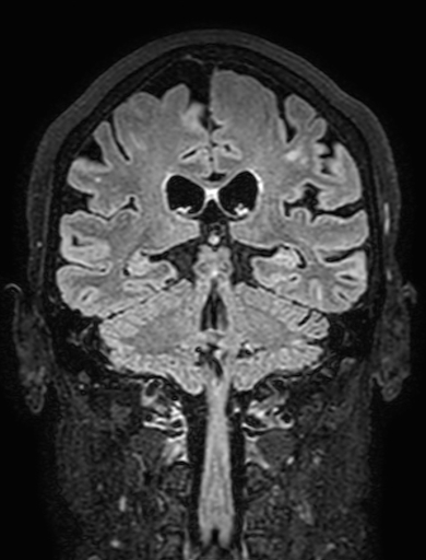 Cavernous hemangioma of the cerebellar falx (Radiopaedia 73025-83724 Coronal FLAIR 217).jpg