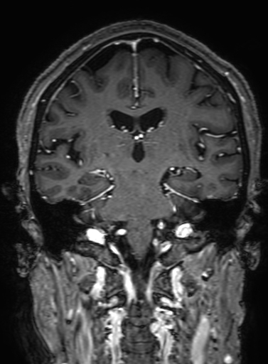 Cavernous hemangioma of the cerebellar falx (Radiopaedia 73025-83724 Coronal T1 C+ 213).jpg