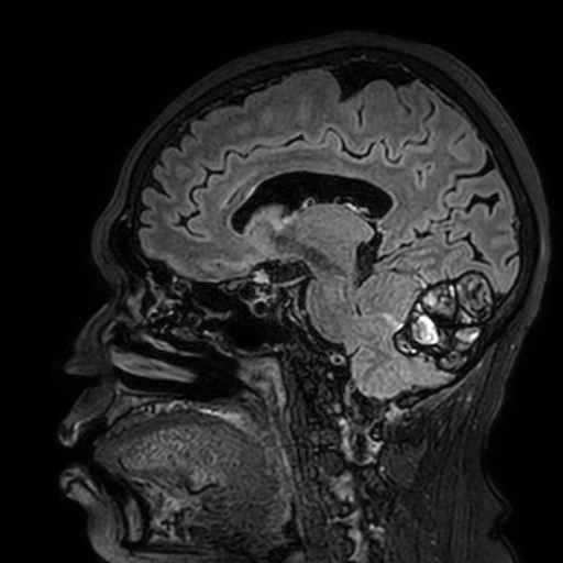 Cavernous hemangioma of the cerebellar falx (Radiopaedia 73025-83724 Sagittal FLAIR 125).jpg