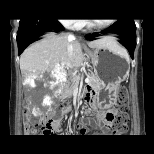 Cavernous hepatic hemangioma (Radiopaedia 75441-86667 C 61).jpg