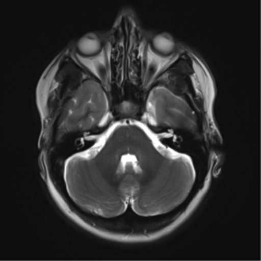 File:Cavernous malformation (cavernous angioma or cavernoma) (Radiopaedia 36675-38237 Axial T2 5).png