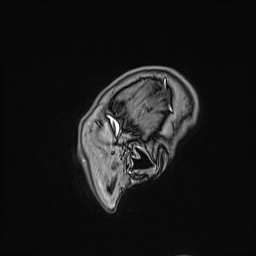 Cavernous sinus meningioma (Radiopaedia 63682-72367 Sagittal T1 C+ 161).jpg