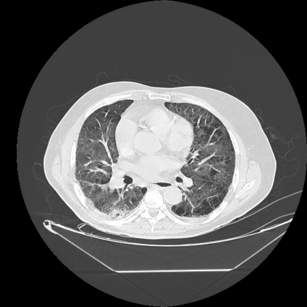 Cavitating bronchogenic carcinoma (Radiopaedia 44489-48162 Axial lung window 46).jpg