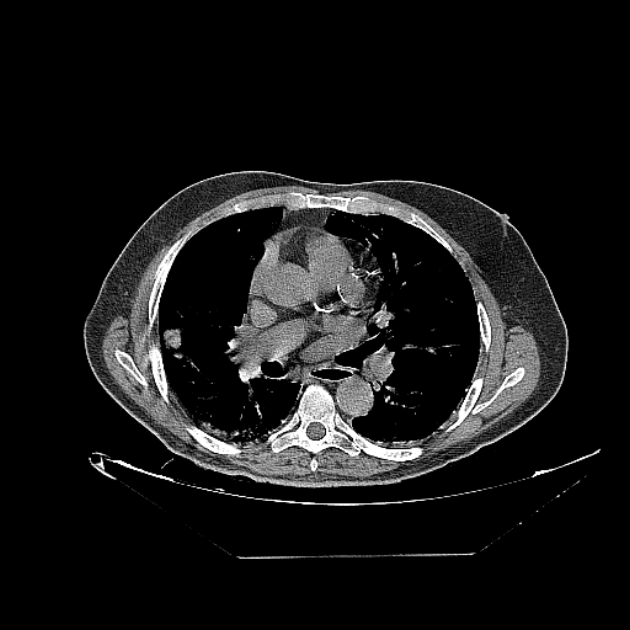 Cavitating bronchogenic carcinoma (Radiopaedia 44489-48162 Axial non-contrast 42).jpg