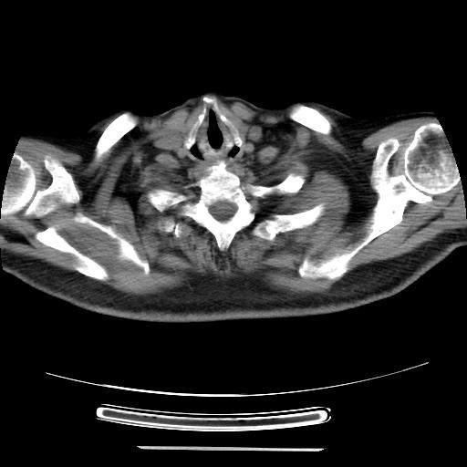 Cavitating pulmonary metastases (Radiopaedia 89545-106544 Axial non-contrast 1).jpg