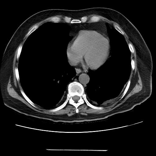 Cavitating pulmonary metastases (Radiopaedia 89545-106544 Axial non-contrast 39).jpg